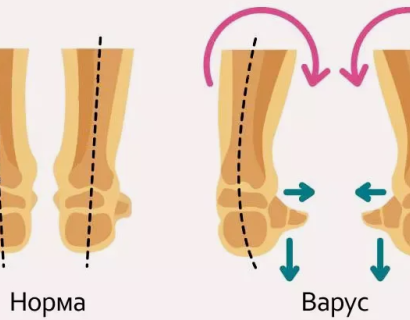 Варусная деформация стоп
