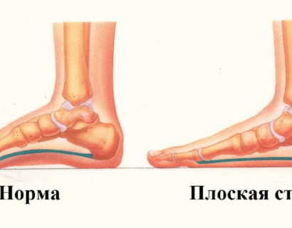 Плоскостопие
