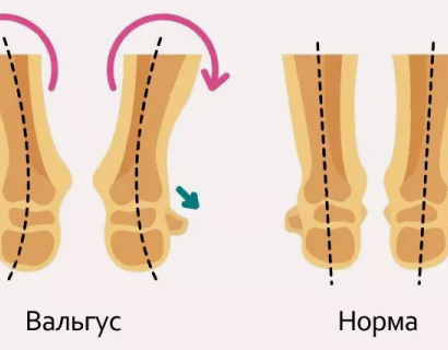 Вальгусная деформация стоп